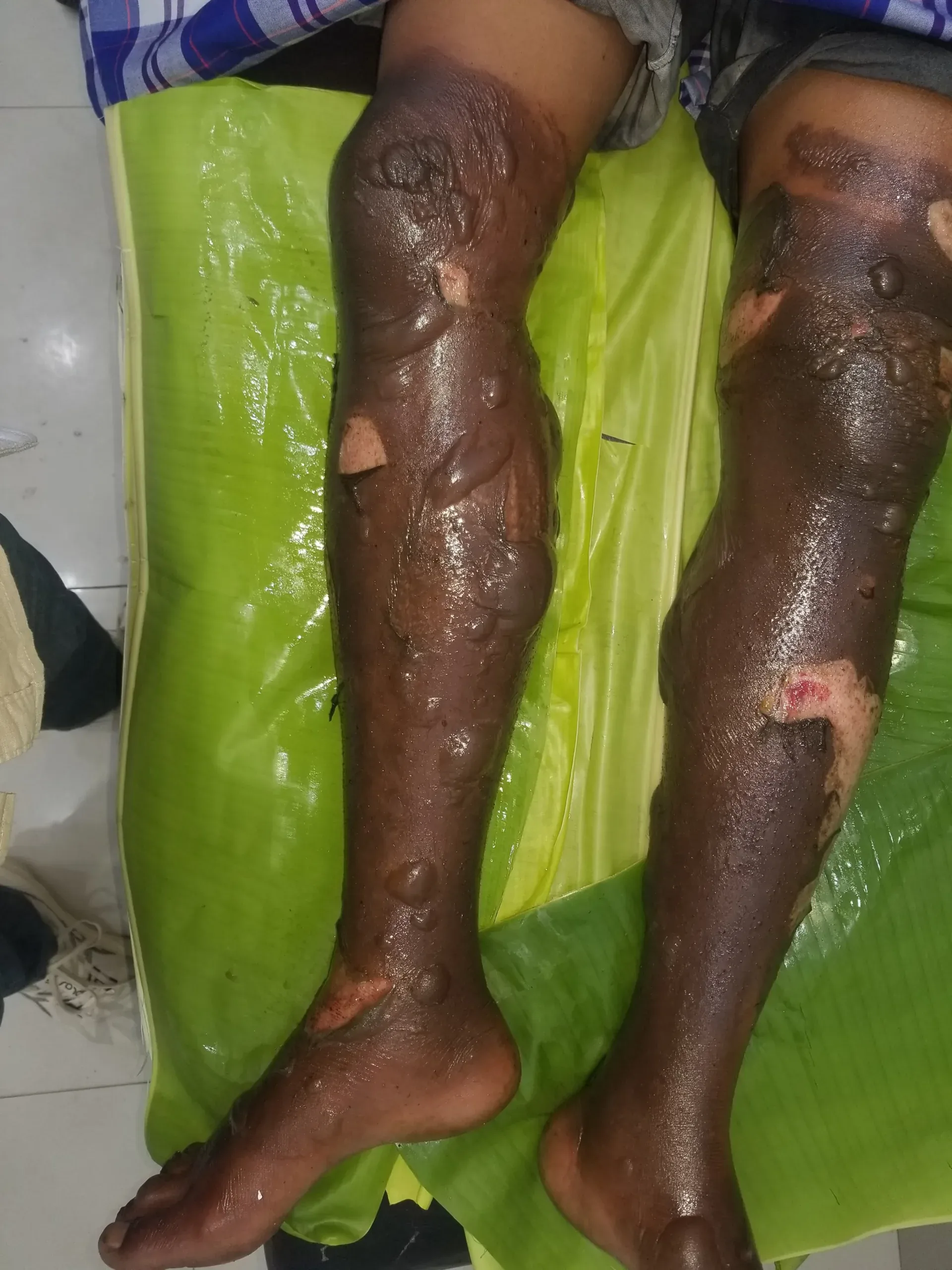 Diduga Bom Ikan Meledak Saat Dirakit, Dua Warga Labbotallua Pulau Tanakeke Alami Luka Serius